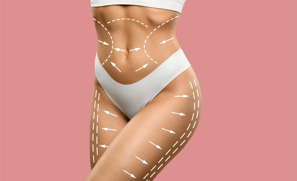 Unveiling Liposuction: A Comprehensive Guide